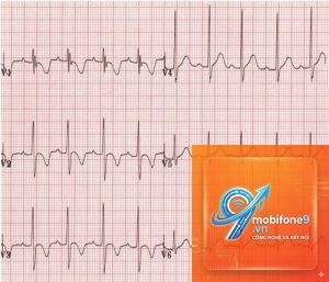 ecg bị treo