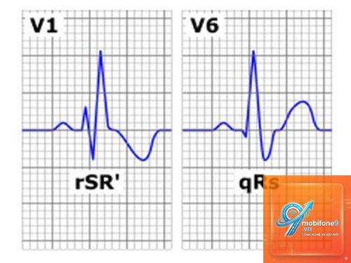ecg bị treo - Hình 4